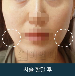 after_Img