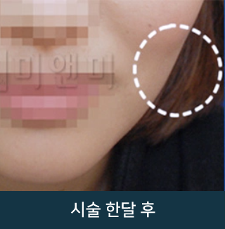 after_Img