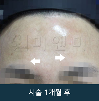 after_Img