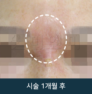 after_Img