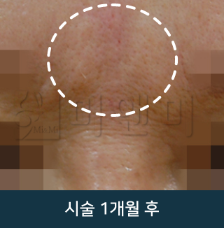 after_Img