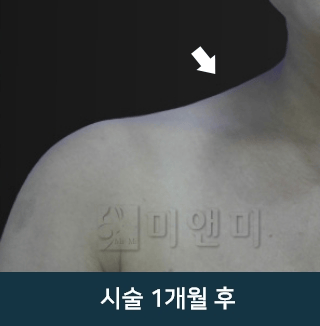 after_Img