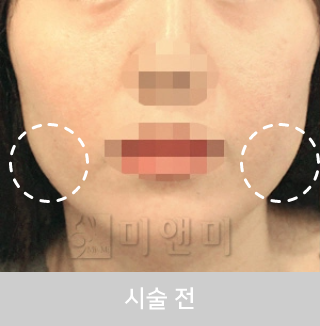 before_Img