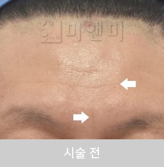 before_Img