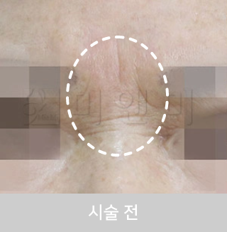 before_Img