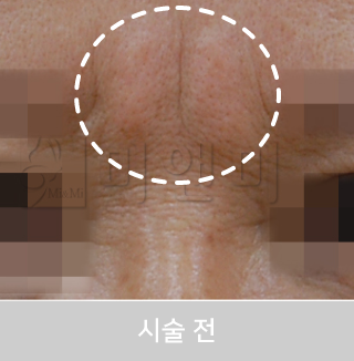 before_Img
