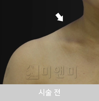 before_Img